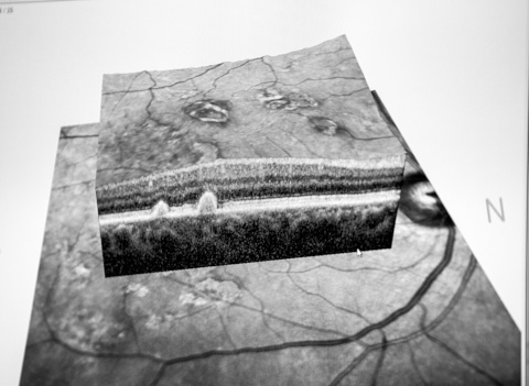 Optical Coherence Tomography